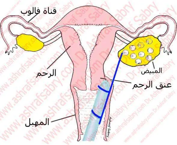شفط البويضات