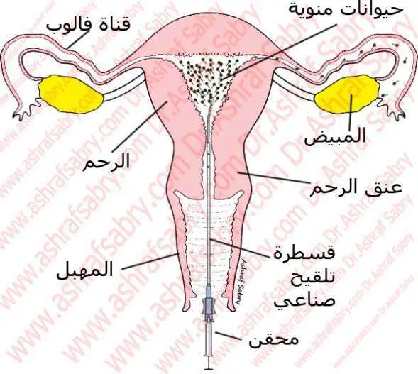 التلقيح الصناعي