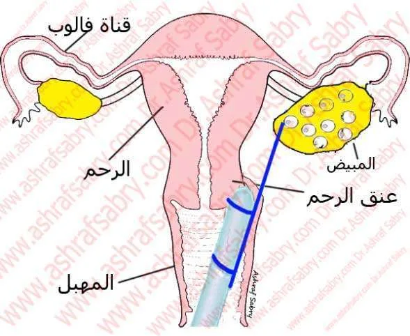 الإخصاب الخارجي