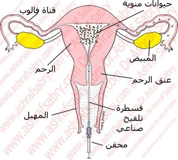 التلقيح الصناعي