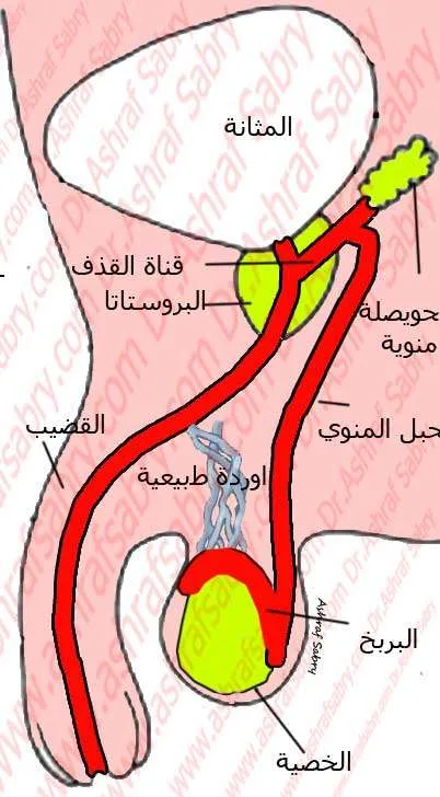 مشاكل في توصيل الحيوانات المنوية الي المهبل