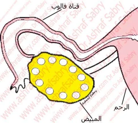 تكييس المبيض