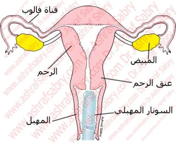 سونار مهبلي