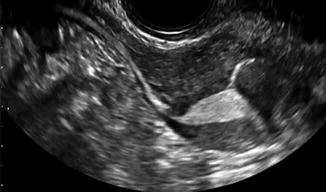 اشعه صبغة الرحم بالسونار