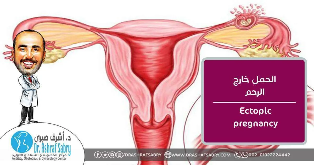 Ectopic pregnancy