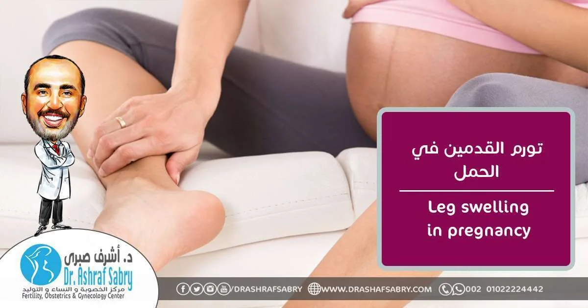 Leg swelling in pregnancy