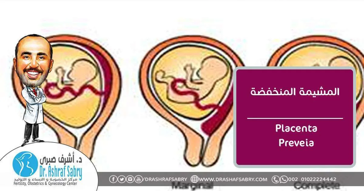 المشيمة المنخفضه